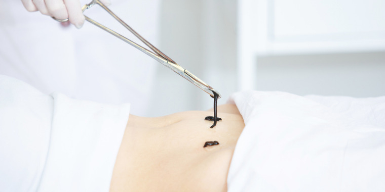 L'hirudothérapie - L'utilisation des sangsues comme anticoagulant naturel